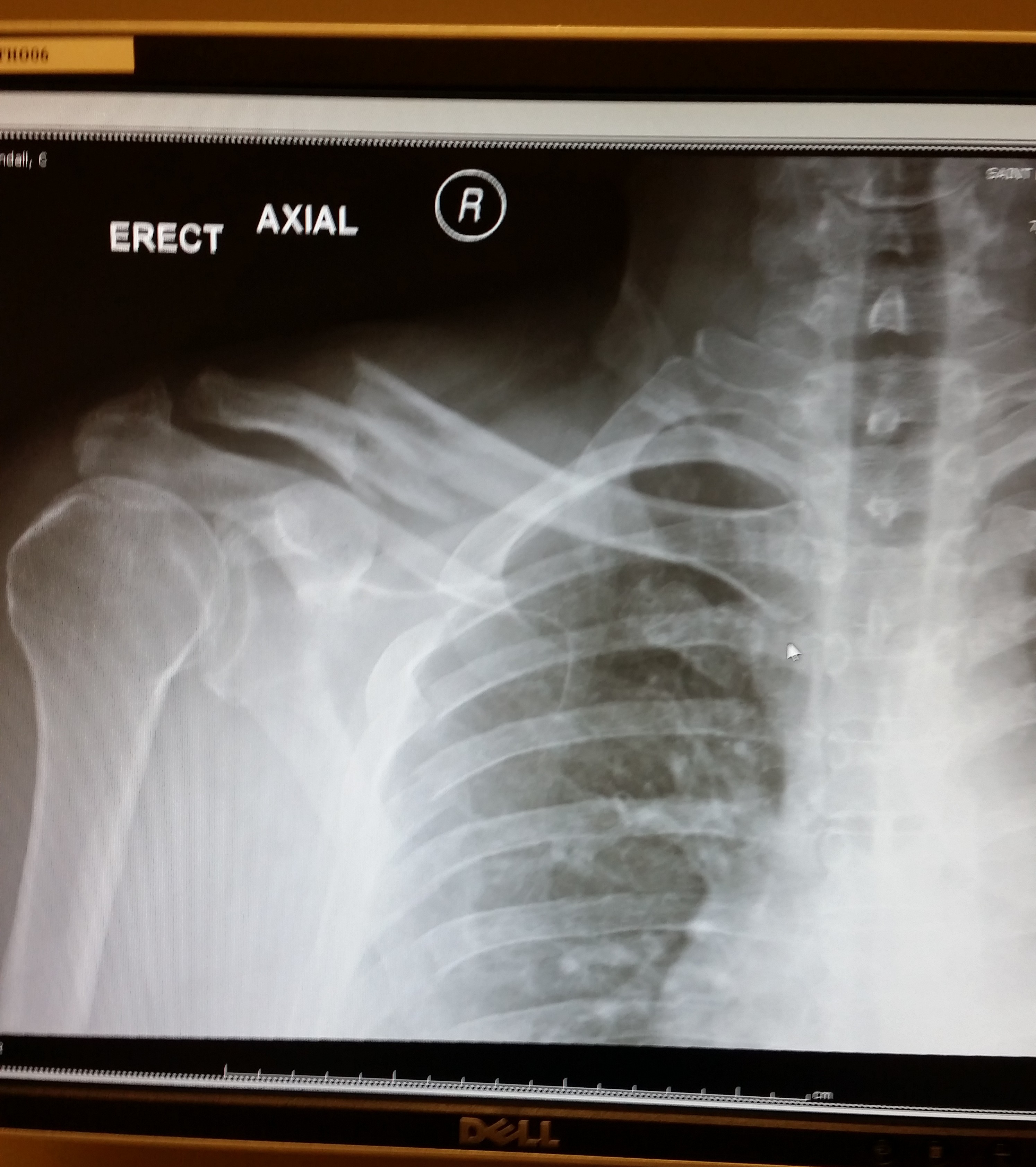 x ray